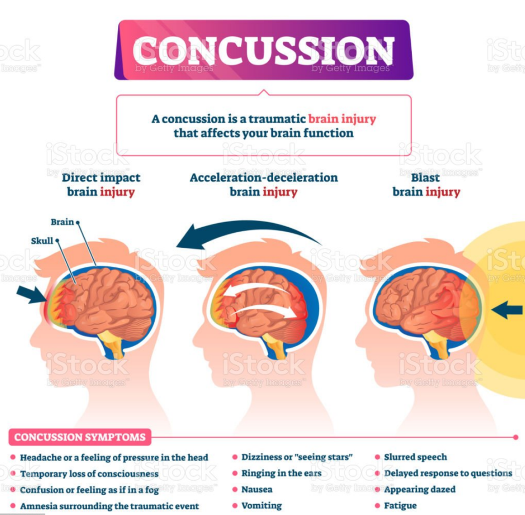 concussion signs and symptoms, blackout, memory loss, dizziness